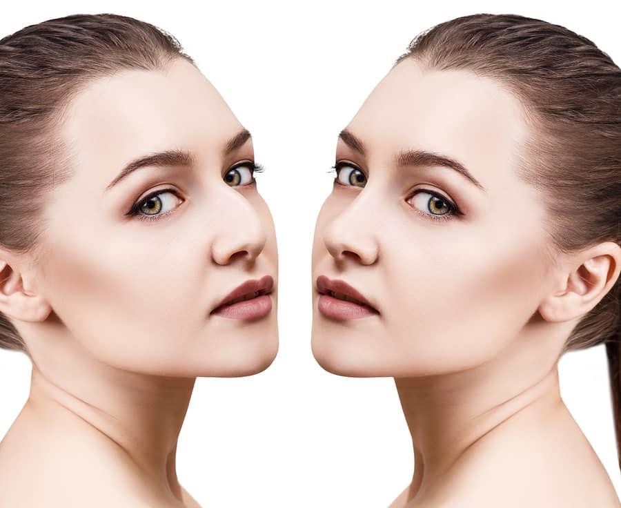 closed vs open rhinoplasty