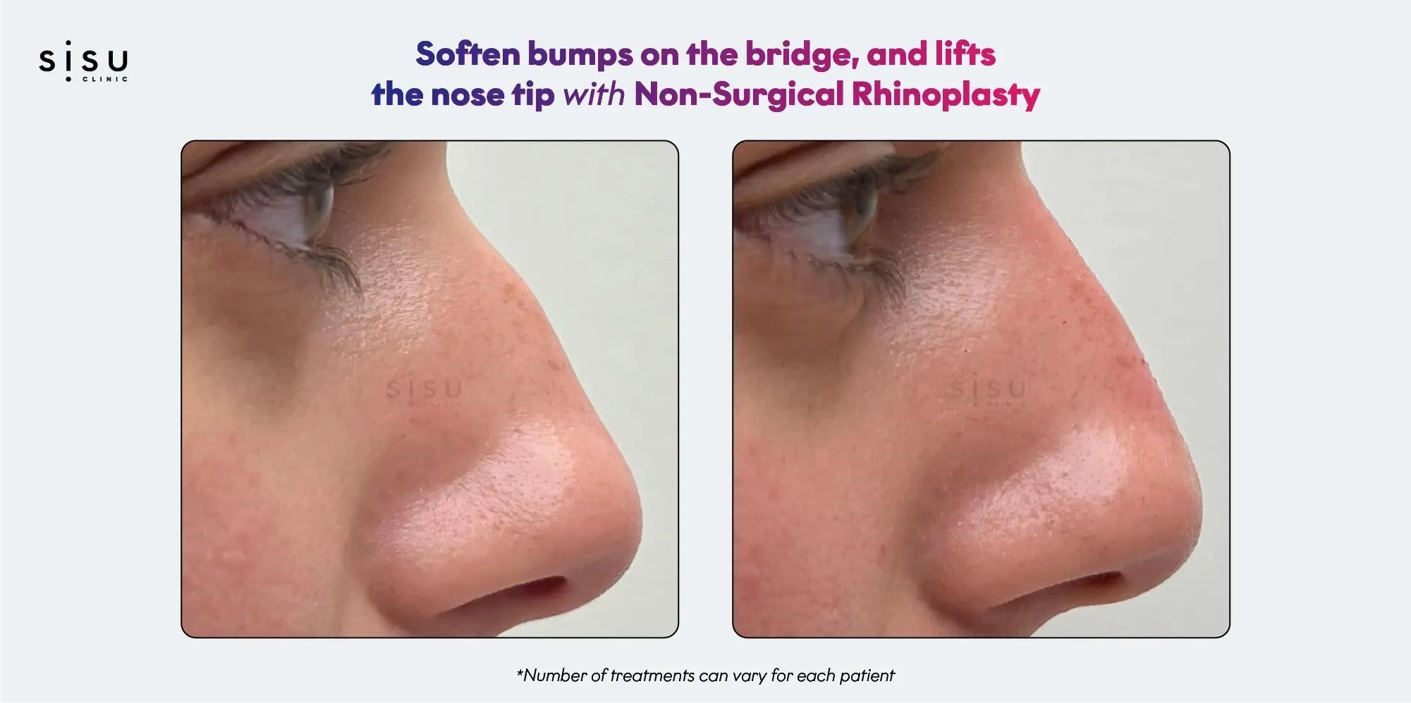 rhinoplasty expert nyc