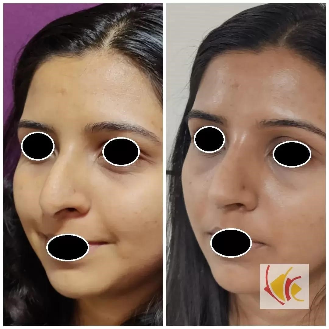 closed vs open rhinoplasty