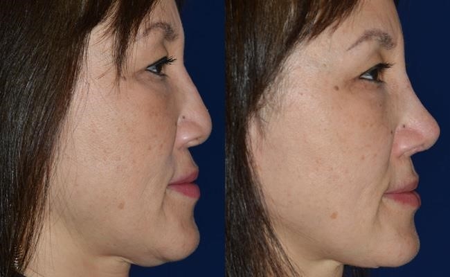 closed vs open rhinoplasty