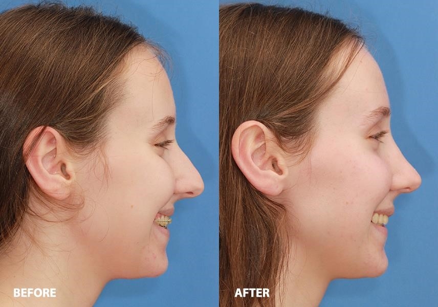 rhinoplasty expert nyc